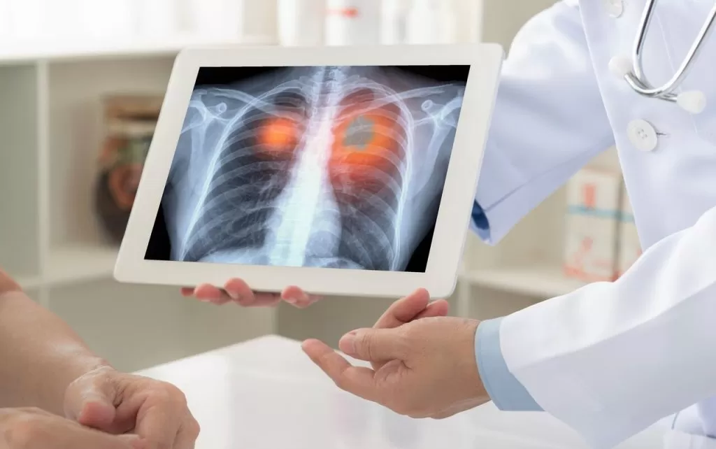 Como funciona a embolia pulmonar